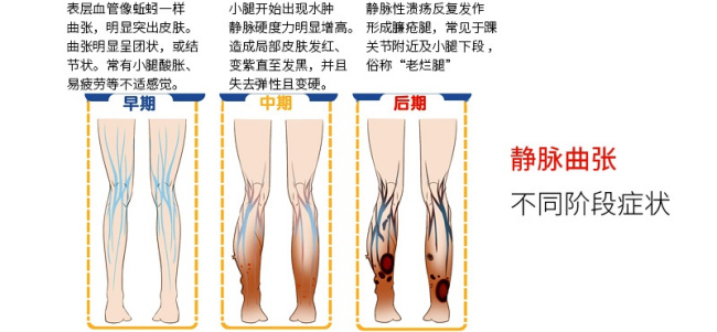 静脉曲张的最严重后果是什么？