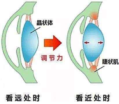 怎样治疗近视?