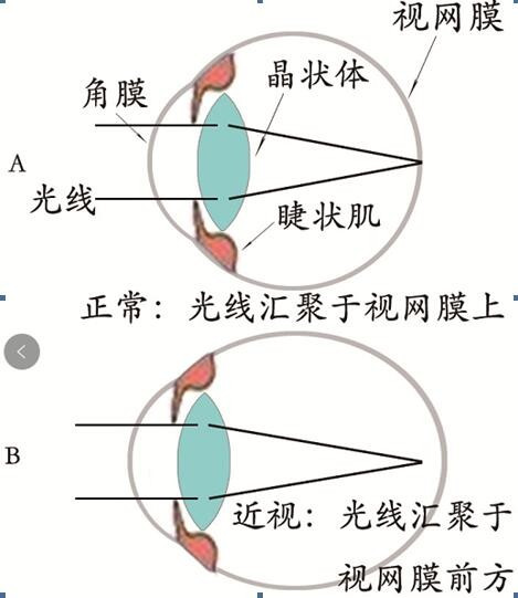 怎样治疗近视?