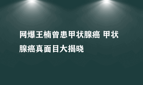 网爆王楠曾患甲状腺癌 甲状腺癌真面目大揭晓