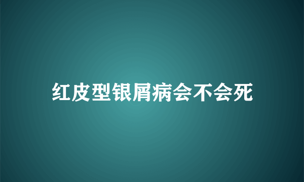 红皮型银屑病会不会死