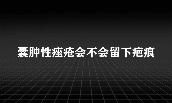 囊肿性痤疮会不会留下疤痕