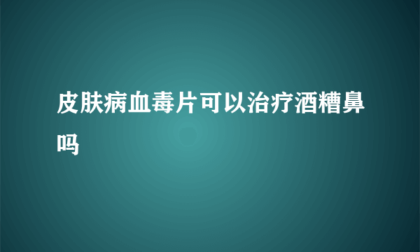 皮肤病血毒片可以治疗酒糟鼻吗