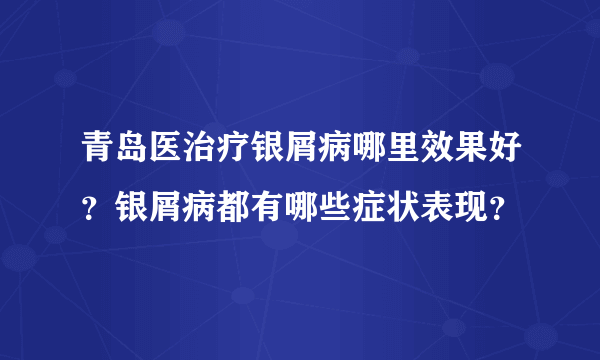 青岛医治疗银屑病哪里效果好？银屑病都有哪些症状表现？