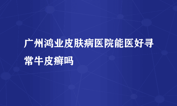 广州鸿业皮肤病医院能医好寻常牛皮癣吗